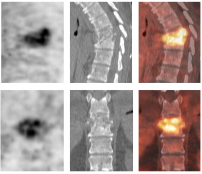 PET SCANS FOR INFECTION